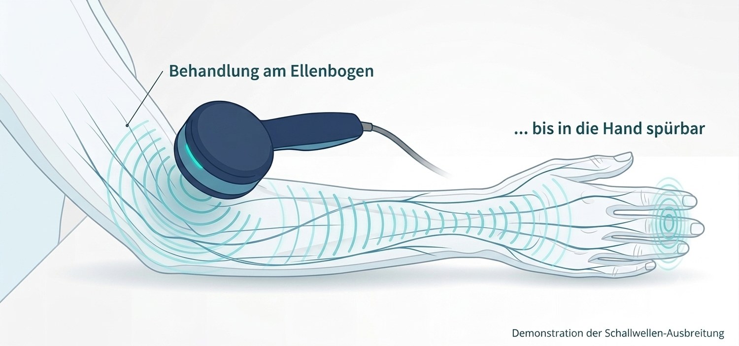 Schematische Darstellung eines Unterarms: Der Applikator liegt am Ellenbogen auf, die Schwingung breitet sich entlang der Strukturen über den gesamten Unterarm bis in die Fingerspitzen aus.